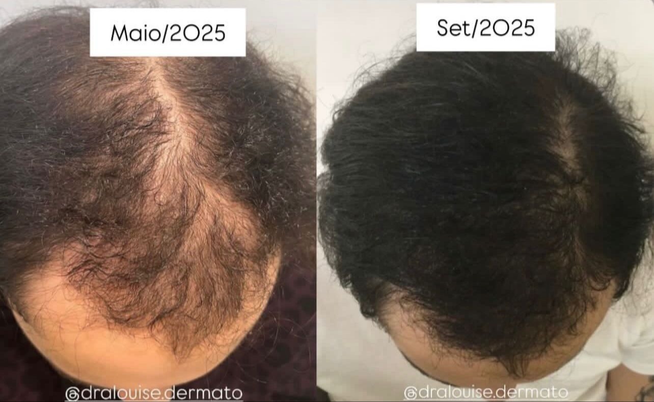 Resultado Hair Growth LC
