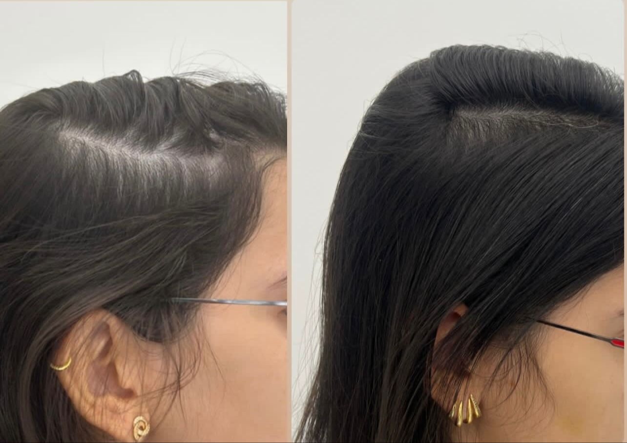 Resultado Hair Growth LC