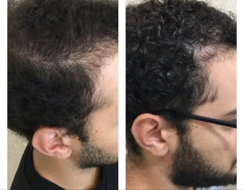 Resultado Hair Growth LC